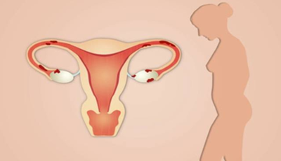 Why Are My Fallopian Tubes Easily "Blocked"? How To Protect Them?