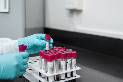 Solving the Problem of 1.9 Million Women: Endometriosis Blood Test Changes the Game!