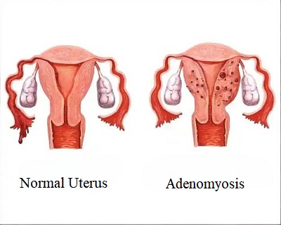 Treat Adenomyosis-Related Menstrual Pain with TCM: An Analysis of Classic Formulas for Activating Blood, Removing Stasis, and Warming the Meridians to Dispel Cold
