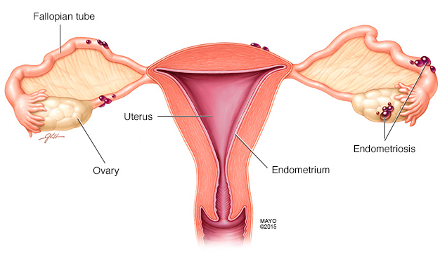 Endometriosis-The treatments and preventions you should learn