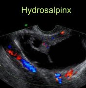 Hydrosalpinx: Causes, Symptoms, Complications, Diagnosis, Treatment, Management and Prevention