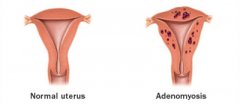 Natural treatment for adenomyosis
