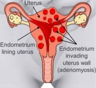 Cure Adenomyosis with Traditional Chinese Medicine