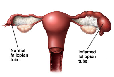 pelvic inflammatory disease