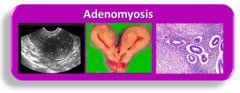 Adenomyosis Treatment Options