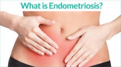 Natural Remedies for Endometriosis Treatment