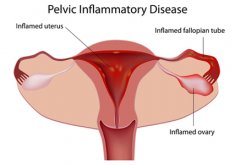 Herbal Medicine for Pelvic Inflammatory Disease (PID)