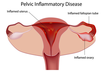 pid natural treatment