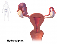 How Does a Hydrosalpinx Cause Infertility?