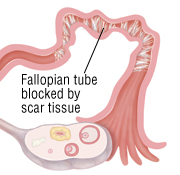 fallopian tubes blockage treatment