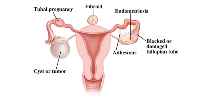 non-surgical endometriosis treatment