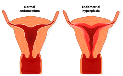 endometrial thickening
