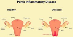 Is there a natural cure for PID?