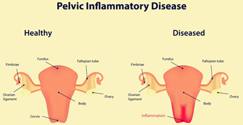 pelvic-inflammatory-disease