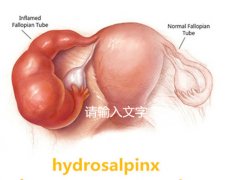 Hydrosalpinx: treatment and causes