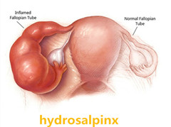 Hydrosalpinx  Treatment