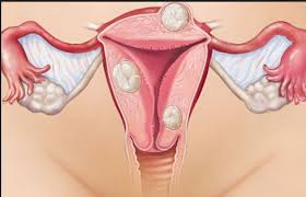recommended endometriosis herbal medicine