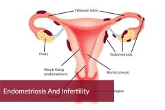 Natural and Effective Endometriosis Infertility Treatment Introduction