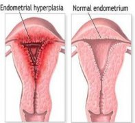 Thick Endometrium Treatment Options
