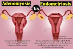 Clinical Identification of Endometriosis and Adenomyosis