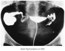 Do You Know the Fundamental Harm of Tubal Effusion?