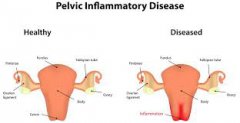 How to Treat Acute and Chronic PID Respectively?