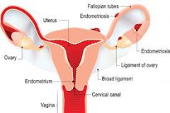 Is it Endometriosis? Check if You Have These 4 Sympotms
