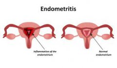 How Endometritis Should be Treated: Etiologic Analysis & Therapeutic Resolution
