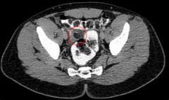 What Are the Specific Symptoms of Pelvic Abscess?