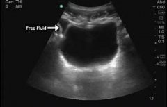 Fennel: A Partial Prescription for the Treatment of Pelvic Effusion