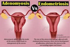 Differentiation Between Endometriosis and Adenomyosis