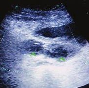 Postoperative Sequelae of Pelvic Abscess