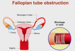 Are There Any Oral Medicine for the Obstruction of Fallopian Tube?