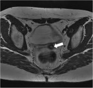 Common Diseases of Fallopian Tube