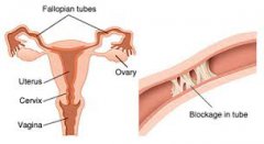 How to Know By Yourself If the Fallopian Tube Is Obstructed or Not?