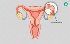 Is It Possible for Women with Blocked Fallopian Tubes to Conceive ?