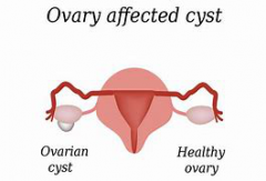 Will the Ovarian Cyst Be Cured without Any Treatment?