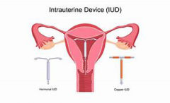 Can Intrauterine Device(IUD) Cause Pelvic Inflammatory Disease?