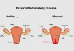  How to Prevent Pelvic Inflammatory Disease(PID)after Childbirth?