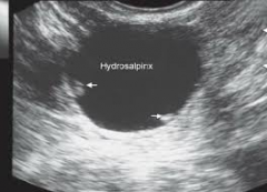 Why Does Hydrosalpinx Cause Ectopic Pregnancy?