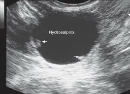 Hydrosalpinx