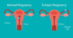 Tubal Anastomosis Causes High Risk of Recurrence of Ectopic Pregnancy