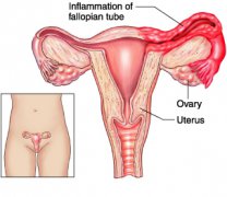 What is the Better Remedy for Salpingitis?