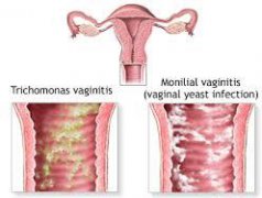 What Kind of Medicine Can be Used to Treat Monilial Vaginitis?