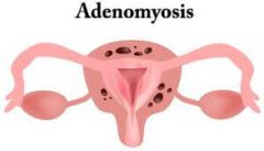 Can Adenomyosis Cause Diarrhea?
