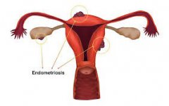 Blocked Fallopian Tubes Caused by Endometriosis Can Be Cured by Chinese Herbal Medicine
