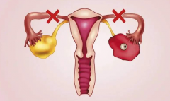 Is Surgical Treatment A Must For Patients With Blocked Fallopian Tubes?