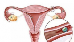 Five Common Causes Of Blocked Fallopian Tubes That Deserve Your Attention