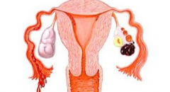 A Therapeutic Target For Endometriosis That Triggers Dysmenorrhea And Infertility Has Been Identified