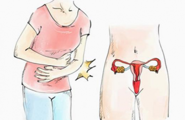 Pelvic Inflammatory Disease Is The Predisposing Factor Of Irregular Menstruation